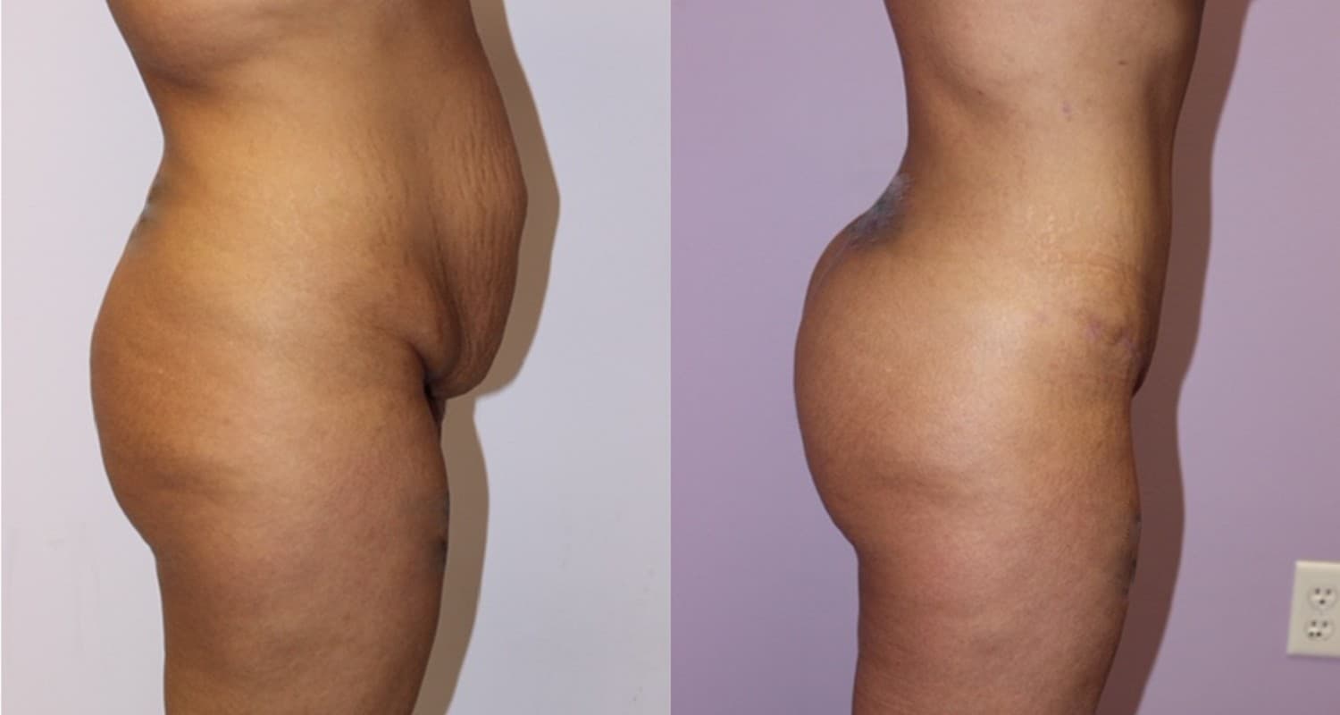 MeTime - Brazilian butt lift with fat transfer versus implants