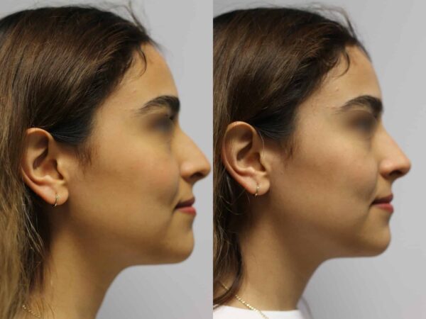 Rhinoplasty Atlanta | Val Plastic Surgery | Cosmetic Surgeon