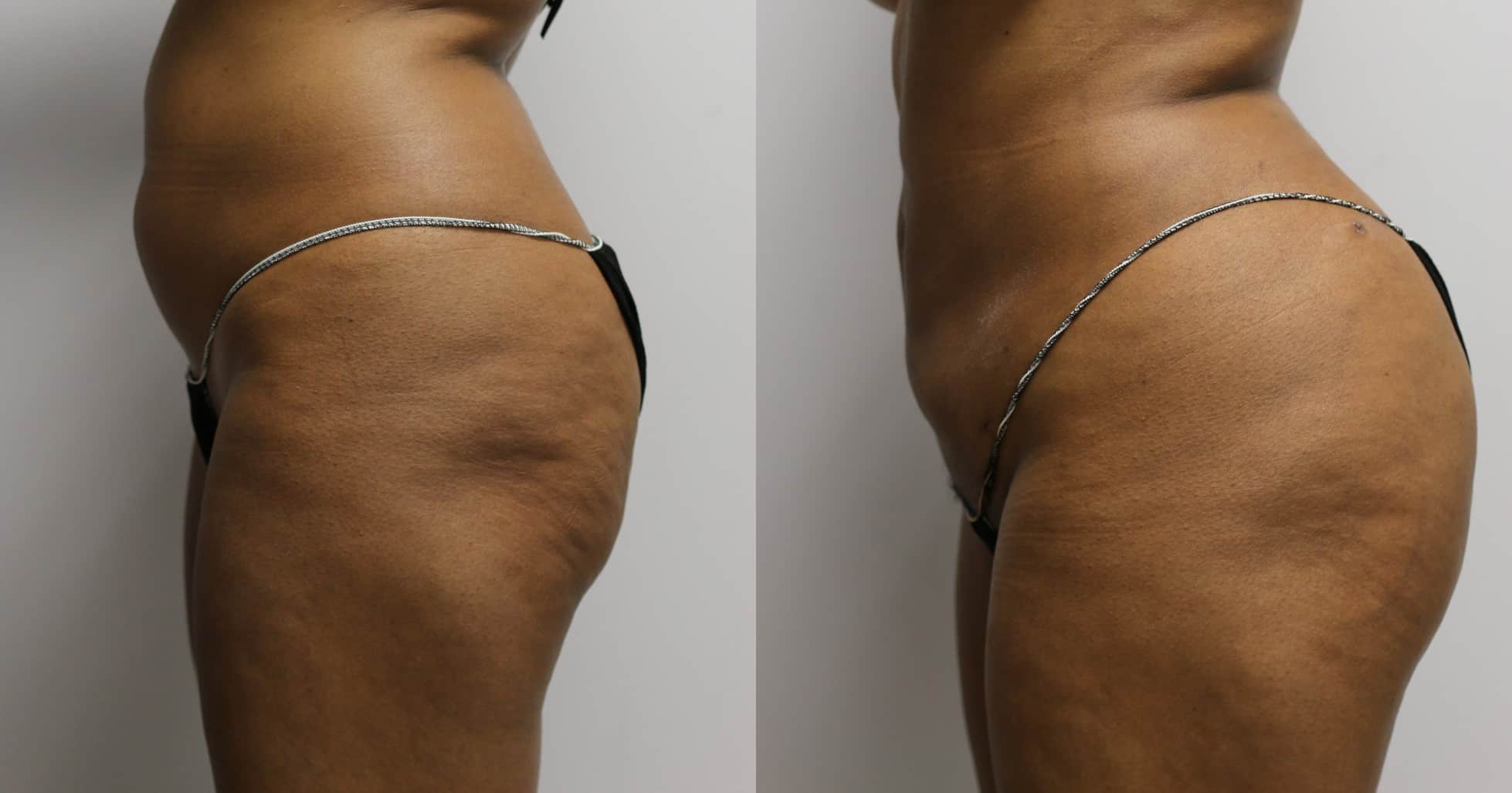 Brazilian Butt Lift (Fat Grafts to Buttocks) Before and After