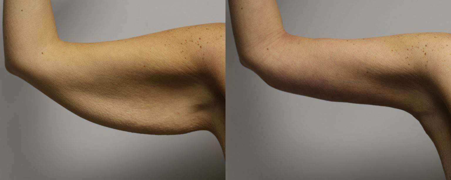 Arm Lift Atlanta Val Plastic Surgery Atlanta Cosmetic Surgeon