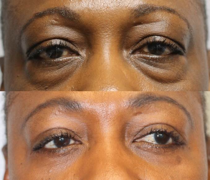 Eyelid surgery shop atlanta