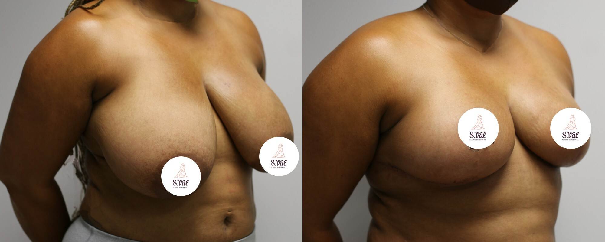 Breast Reduction Atlanta, Val Plastic Surgery